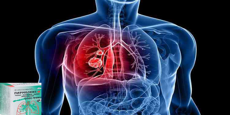 Parmalex και πνευμονική βλάβη